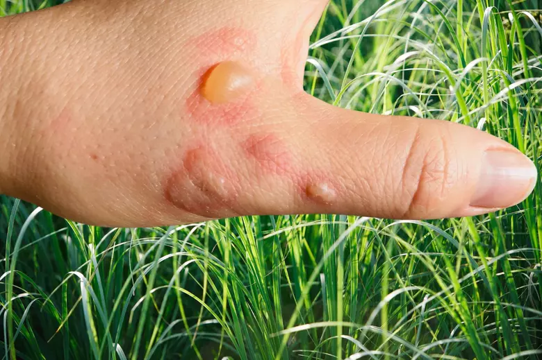 Giant Hogweed in New York: A Dangerous Threat Causing Severe Skin Reactions